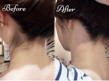 ピミル(PIMIL)/うなじ脱毛