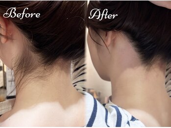 ピミル(PIMIL)/うなじ脱毛