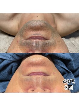 モデルズ 名古屋(MODELS)の写真/名古屋でヒゲ脱毛するならMODELSにお任せください。最短で結果出します。