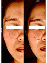 エービューティ(A.beauty)/モニター様 Before&After