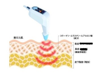 リベル(Liber)/エクシリスでコラーゲン細胞活性