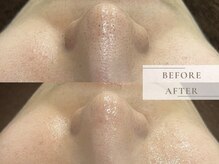 レヴィア(Revia)/ハーブピーリング＆毛穴洗浄