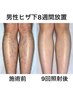 【メンズ限定】ホットジェル美肌脱毛足全体