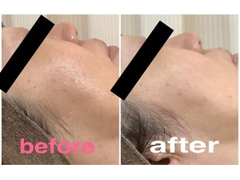 リマインド(ReMind)/日焼け