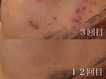 ホワイトアクア 中目黒店(WHITE AQUA)/ハーブピーリング/ニキビ/中目黒