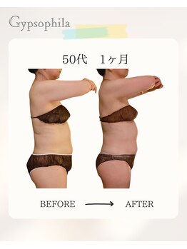 ジプソフィラ(Gypsophila)/痩身ビフォーアフター