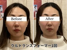 スピード小顔 渋谷店 (Speed)/体験ビフォーアフター