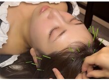 チョコバリ 恵比寿店(chocobari)/小顔リフトアップ（美容鍼）20代