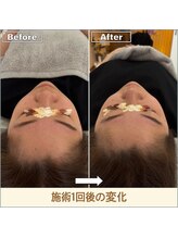 フィンチ(Finch)/小顔矯正1回後の変化