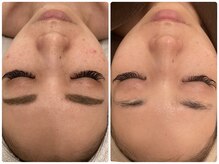 ニコリ(Nicori)/クリスティーナで肌質改善♪