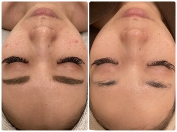 ニコリ(Nicori)/クリスティーナで肌質改善♪