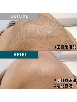 モモナ(Momona)/佐世保/脱毛/髭脱毛/全身脱毛