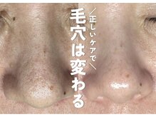 ホワイトアクア 鹿児島店(WHITE AQUA)/韓国肌育ララピール3回目/毛穴