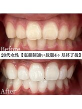 ホワイト 福岡博多店(WHITE)/ホワイトニングビフォーアフター