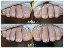 爪切り屋 足楽/【肥厚爪】