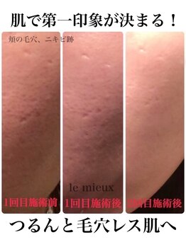 ル ミュー(le mieux)/剥離しないハーブピーリング