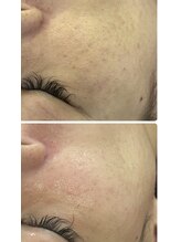 イノエ(inoe)/【毛穴キュッ】