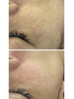 イノエ(inoe)/【毛穴キュッ】