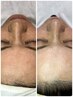 月・水限定 爽快感がやみつきに。白ニキビ、くすみ、ごわつきにお悩みの方。