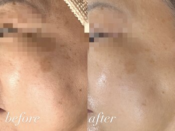 ビューティーサロン プティ(beauty salon petite)/【しみケア/シミ改善】美白ケア