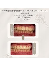 プラスビーセルフ(+b self)/ホワイトニングビフォーアフター
