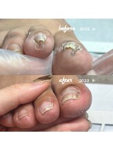 ネイルサロン ユーズ(USE.)/【巻き爪ケア】ビフォーアフター