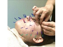 高田馬場名倉堂鍼灸接骨院/美容鍼