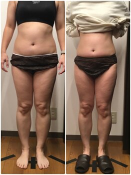 美容整体ユメカ(美容整体YUMEKA)/お腹・脚ラジオ波施術