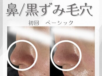 アン ネイル(ANN NAIL)/鼻/黒ずみ毛穴改善