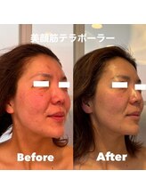 ティアラ(TIARA)/【小顔、たるみ】テラボーラー