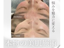 10回のハーブピーリングで赤ら顔・毛穴の開き・くすみ改善へ☆