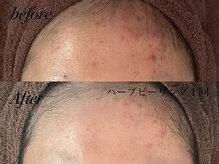 アンドナイン エス店(ANDNINE.)/ニキビハーブピーリング