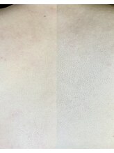 十美/【産毛サヨナラ♪】before after