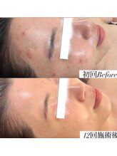 ホヌ(Honu)/ハーブピーリング12回コース★