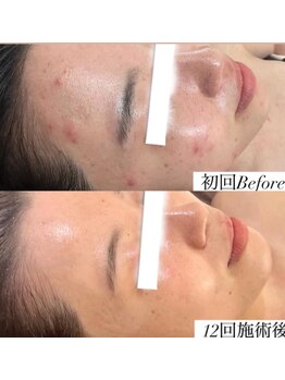 ホヌ(Honu)/ハーブピーリング12回コース★