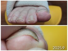 爪切り屋 足楽/【巻き爪リフトアップ】