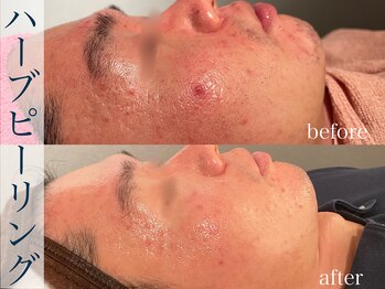 モア 星ヶ丘店(MORE)/ハーブピーリング