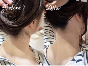 ピミル(PIMIL)/うなじ脱毛