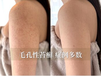 ピブ(PIBU)の写真/《二の腕ブツブツ改善》症例多数!つるつる二の腕を定入れるチャンス☆ニキビ/毛穴洗浄/二の腕ケア
