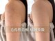 ピブ(PIBU)の写真/《二の腕ブツブツ改善》症例多数!つるつる二の腕を定入れるチャンス☆ニキビ/毛穴洗浄/二の腕ケア