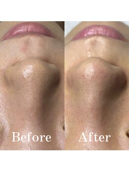 ティーツリー 名古屋 桜山(Tea Tree)/黒ずみ取って艶肌トーンアップ！