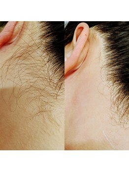 ジョリーズ(jolie's)/うなじWAX脱毛