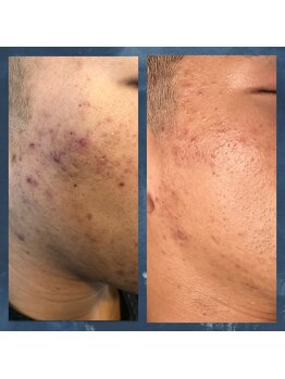 ヴィヴ コレビ(VIV COREBI)/ニキビケア