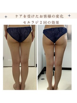 サロン叶(kanau)/頑固なセル脂肪撃退