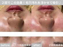 サロン ビュー(salon view)/10代女性〈毛穴黒ずみ悩み〉