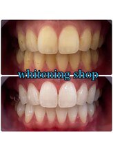 ホワイトニングショップ 吉祥寺店/BEFORE ＆ AFTER
