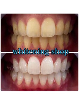 ホワイトニングショップ 吉祥寺店/BEFORE ＆ AFTER
