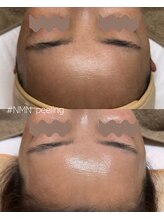 サロン ミジュ(salon MiJU)/NMNピーリング