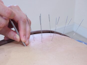 せせらぎ鍼灸院の写真/【ルート鍼灸/首肩こり/頭痛/眼精疲労】頭、首肩まわりのお悩み、お任せください!