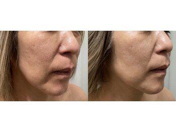 ルボン(RUBON)/リフトアップ